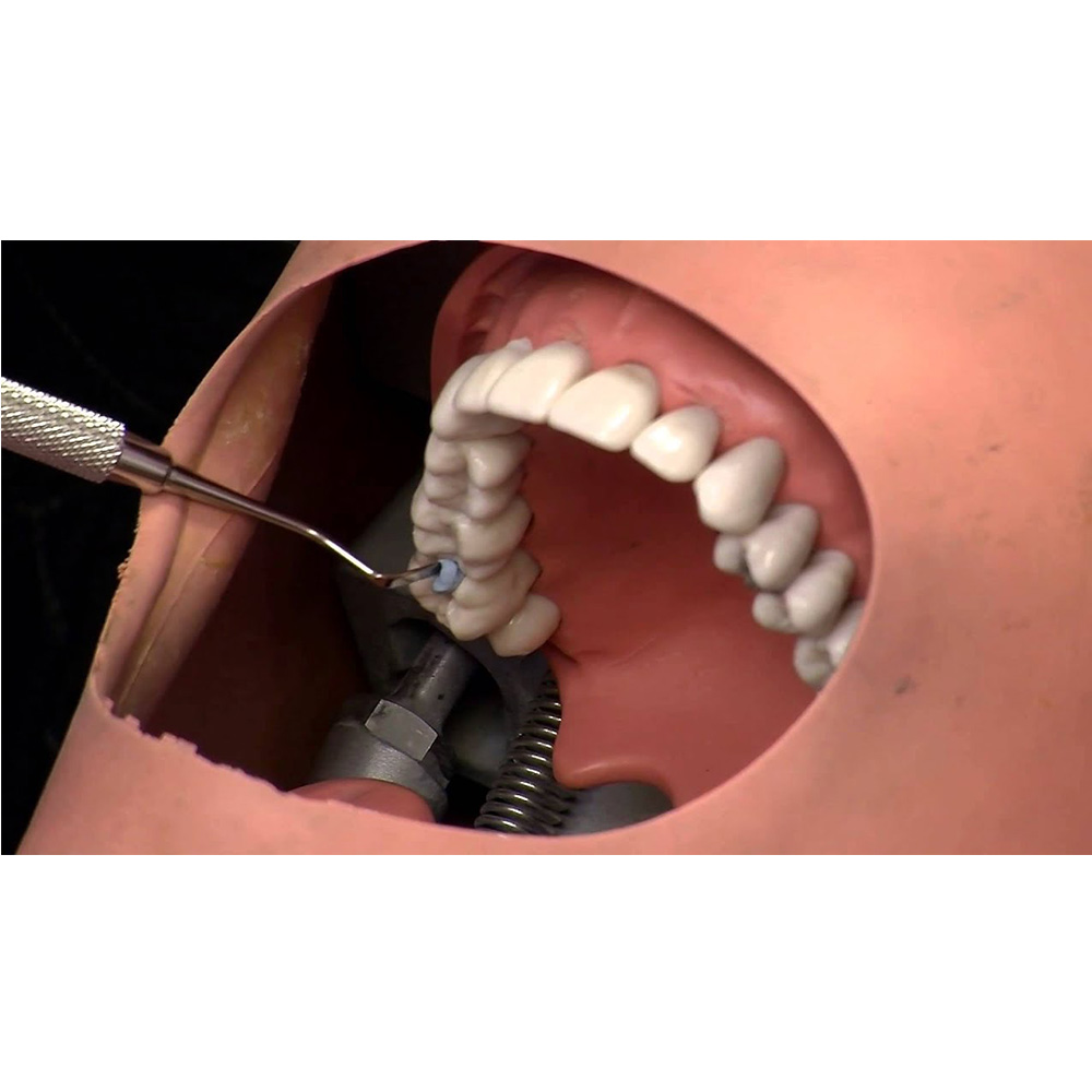 GDC Plastic Filling Instrument - 4 (PF21)