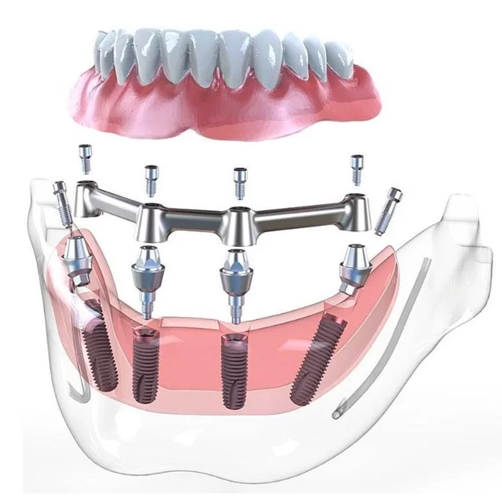 Xcem Dental Implant Submerged Conical Multi Unit Abutment