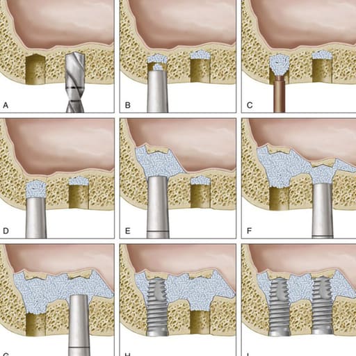 GDC Osteotomes Convex - Angulated (Ostmsp42a)
