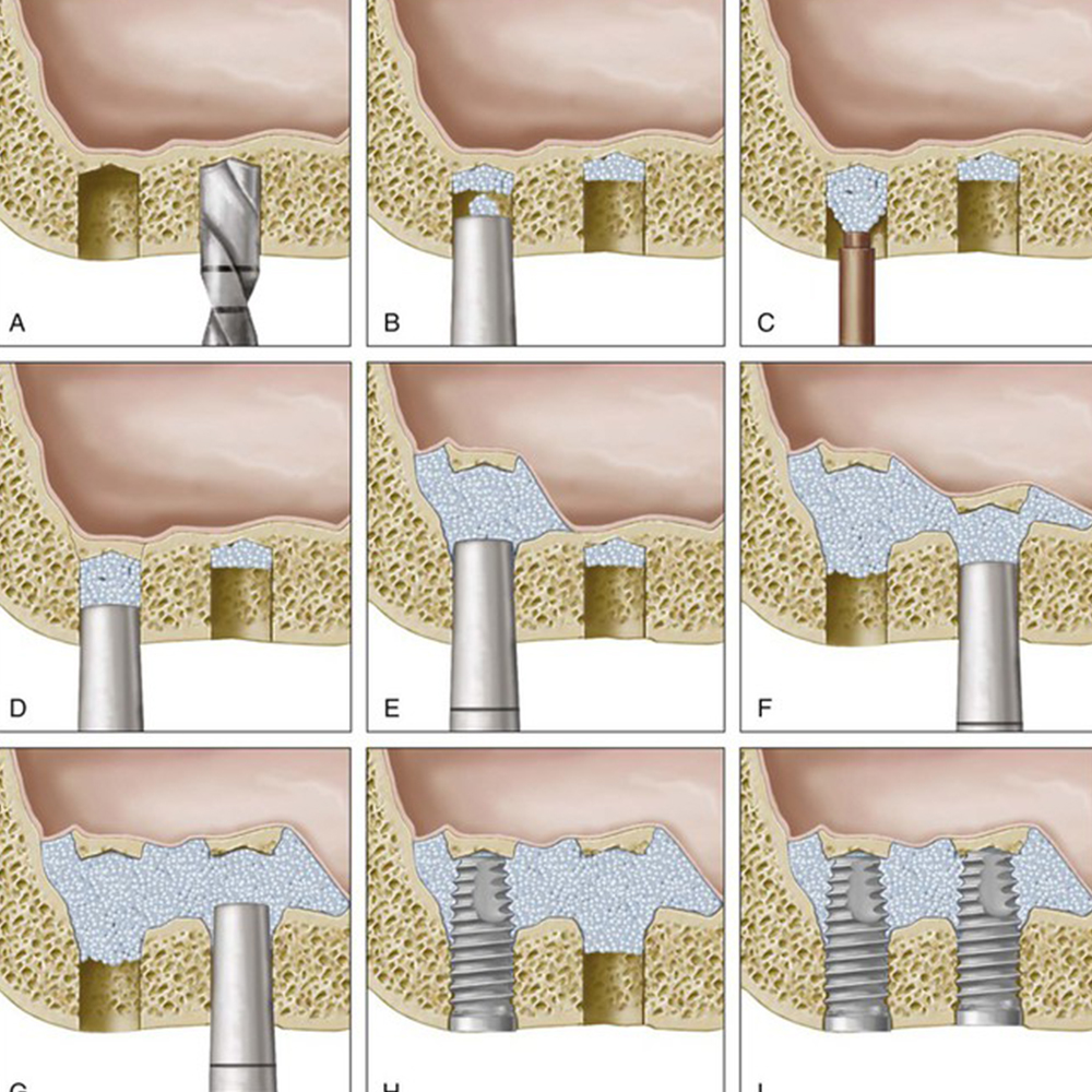 GDC Osteotomes Convex - Angulated (Ostmsp50a)