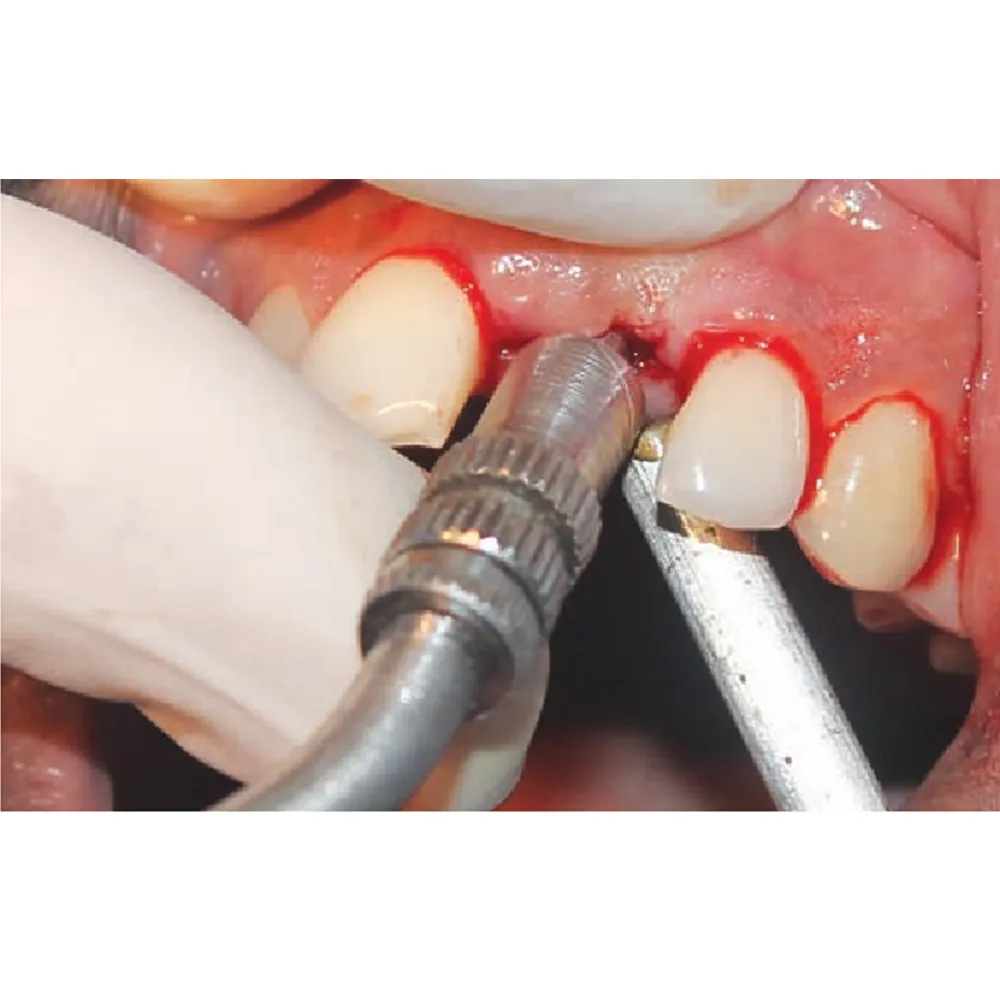 GDC Osteotomes Convex - Angulated (Ostmsp37a)