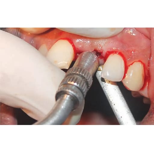 GDC Osteotomes Convex - Angulated (Ostmsp42a)