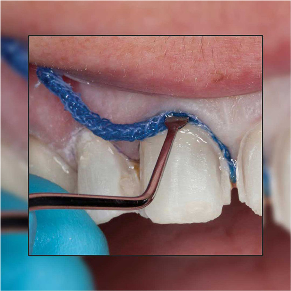 GDC Gingival Cord Packer Serrated #4 (Hollow Ring Handle) - GCPAS113