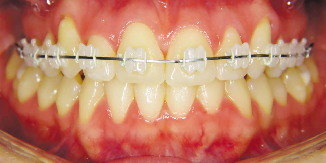 Phyx Nova Ceramic Brackets