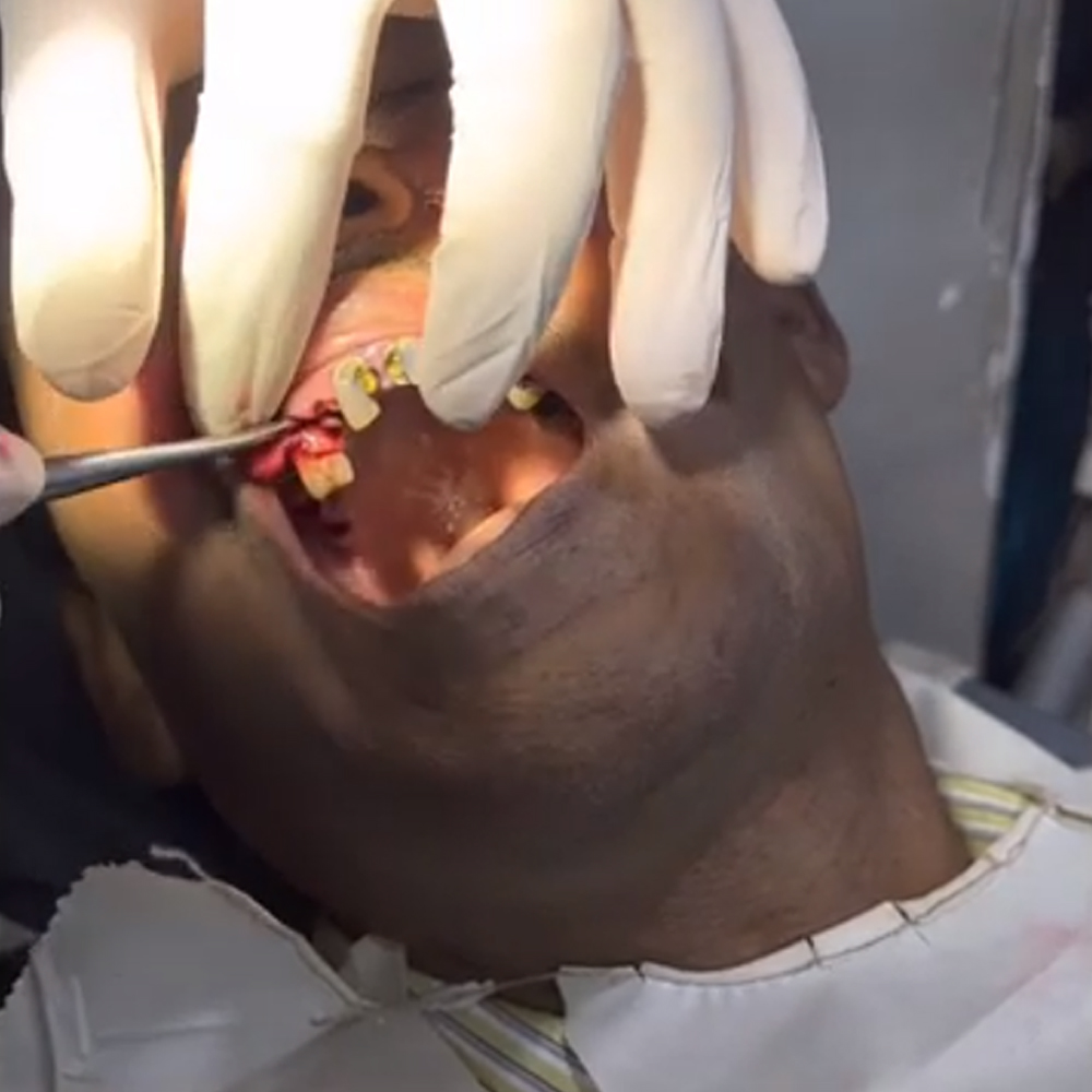 Waldent Coupland Root Elevator #3 - Straight (2/107)