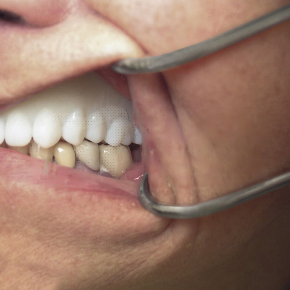 Oracraft Columbia Retractor (CRC)