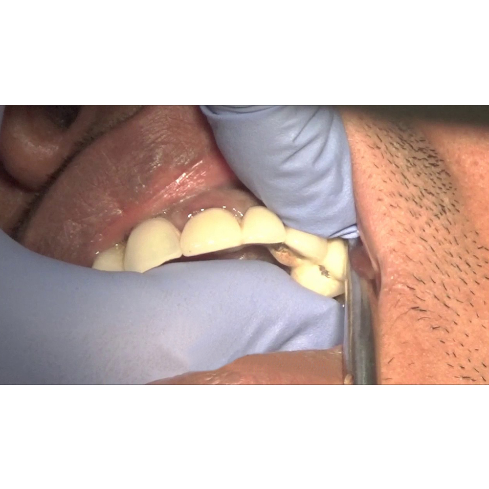 GDC Automatic Crown Remover Standard (CRS)