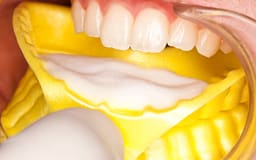 Cotisen Disposable Fluoride Foam Tray - 13