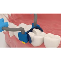 Polydentia MyQuickmat Classico Sectional Matrix Kit & Refills - 5