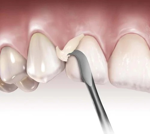 GI Dental Cumine Scaler