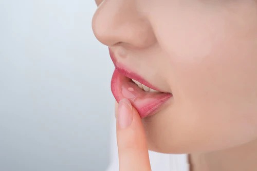 Curatick Oral Wound Dressing (Pack of 10) (Short Expiry 06-2026)