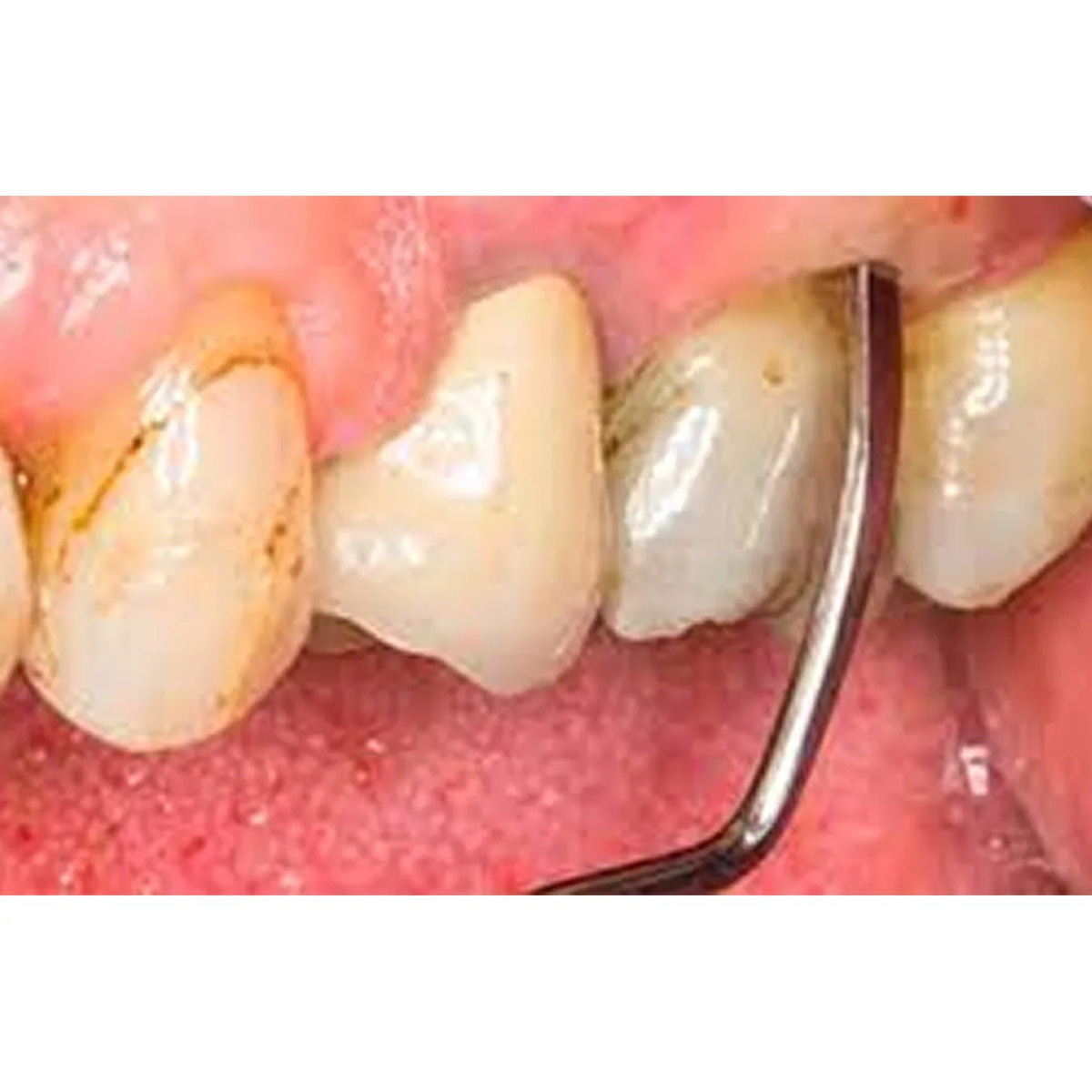 American Eagle Universal Curettes Columbia 4L-4R Montana Black