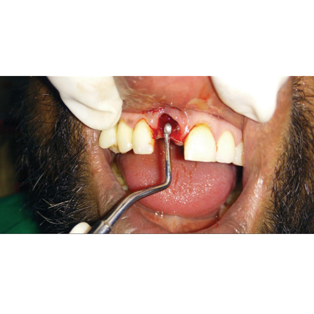 GDC Lucas Surgical Curettes