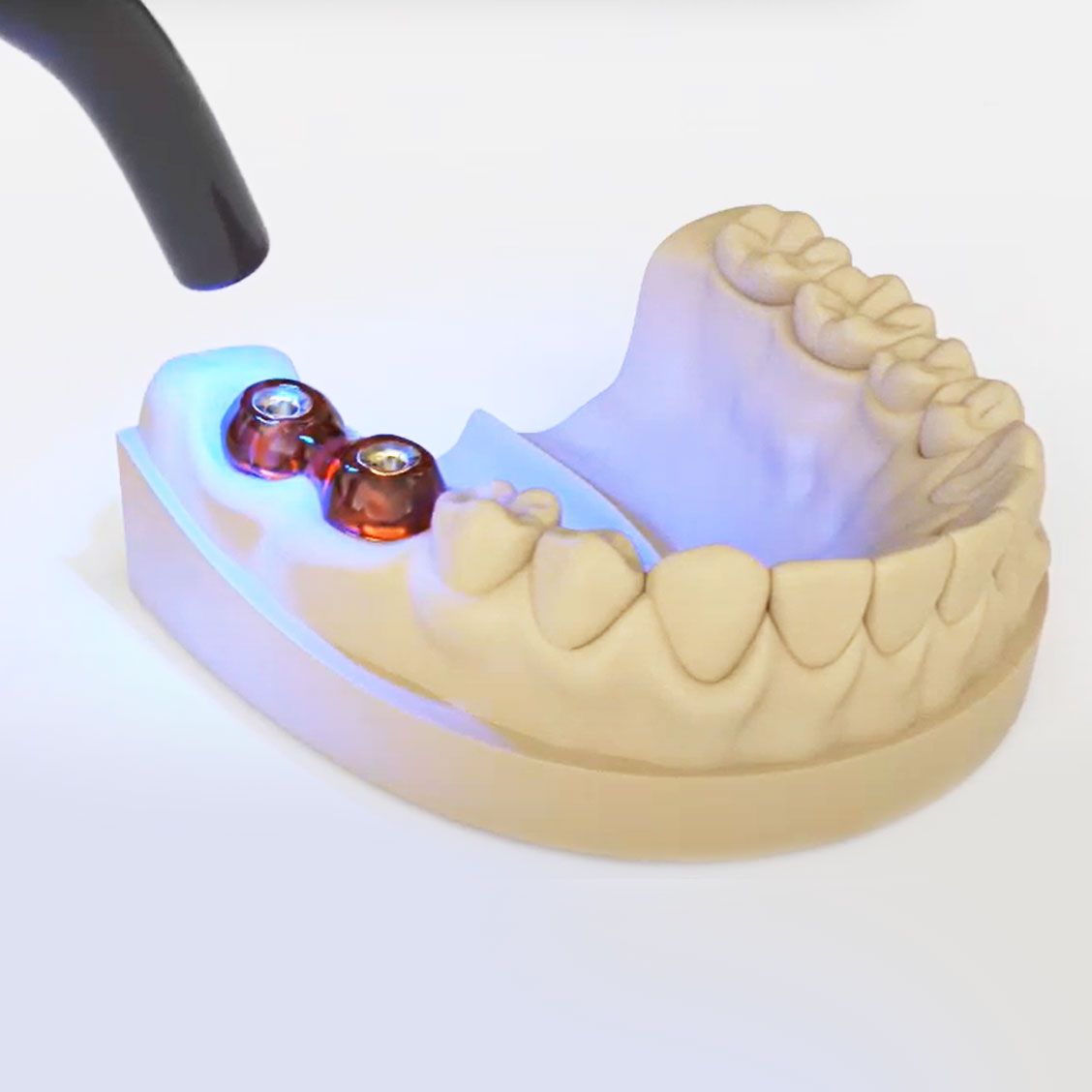 Alphadent EZ - Pattern LC For Dental Implant