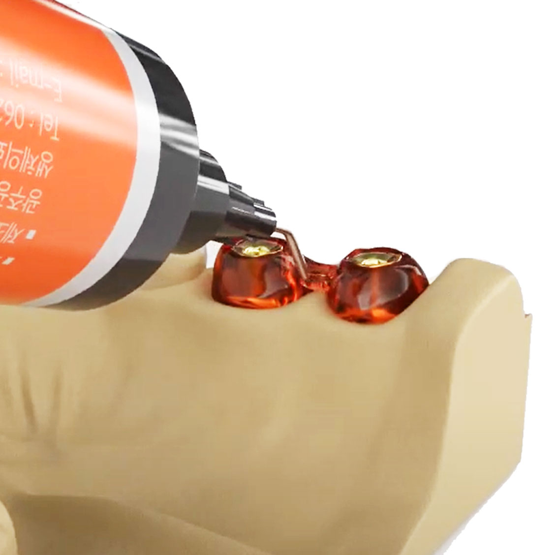 Alphadent EZ - Pattern LC For Dental Implant