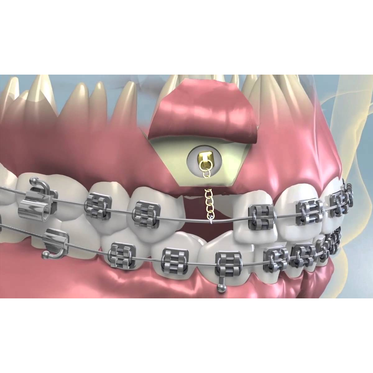 JJ Ortho Button And Chain Eruption Appliance (60.01.69E)