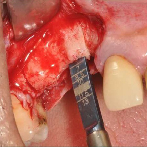 Julldent Ridge Splitting Chisel Offset Set of 4