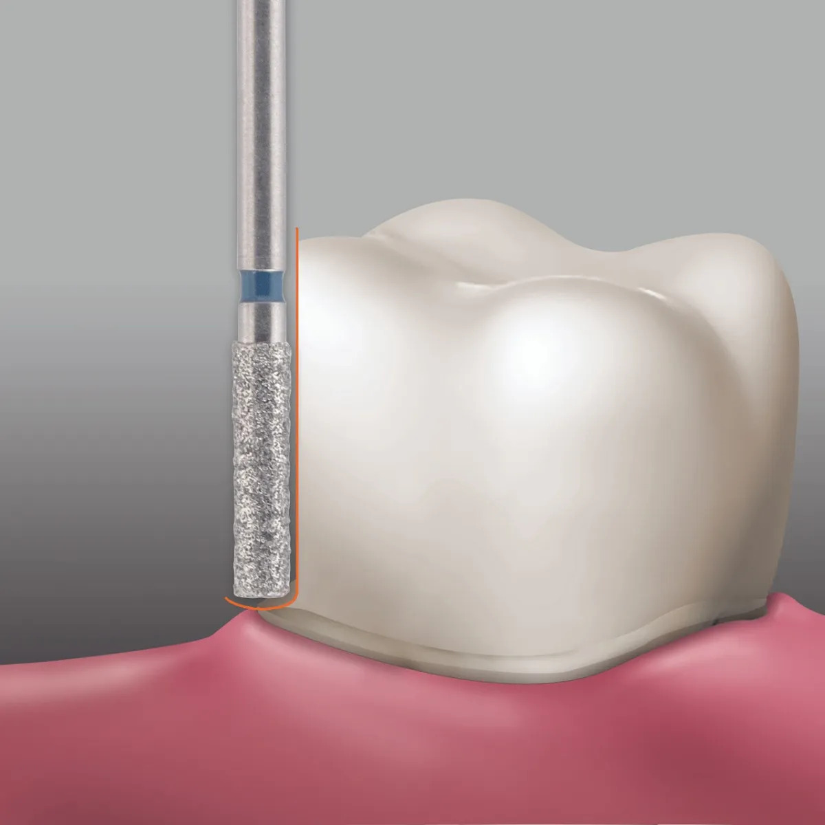 Frank Dental Cylinder Flat End FG Diamond Bur - Pack of 5