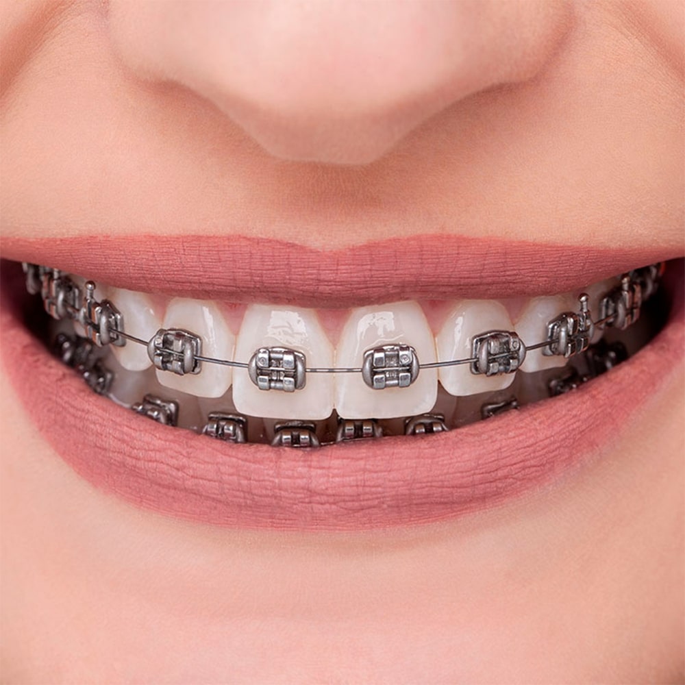 OrthoMetric Advanced Series Metal Bracket Kit MBT 022 (100 Cases) - 10.11.2913