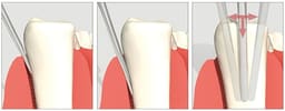 Veecare Extended Shank Spade Elevator - 5