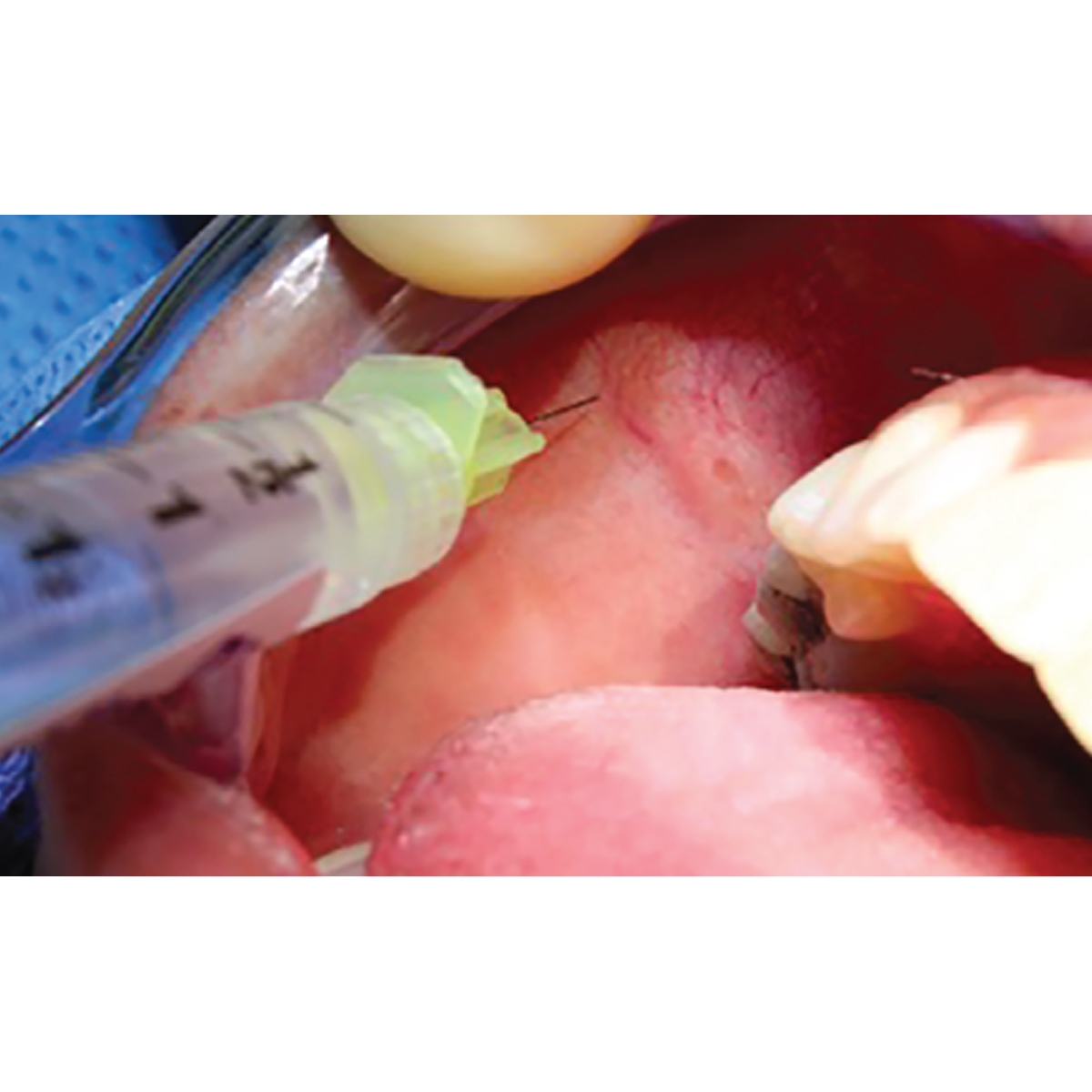 Dentaids Lidayn Lignocaine Injection With 2% Adrenaline (Pack of 12)