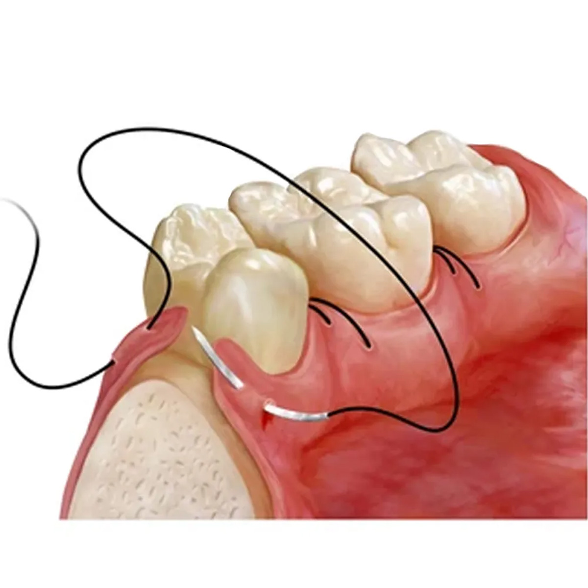 Meril Filasilk Black Braided Silk Suture Reel #3-0 (SLK30 822R) - 25Mtr