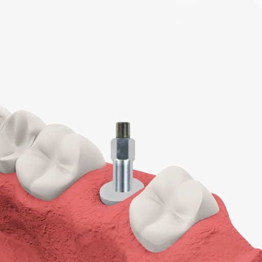 DentalPlant Alpha Bio ATI IH | ATID IH |ICE IH|NEO IH |SPI IH Compatible SmartPeg