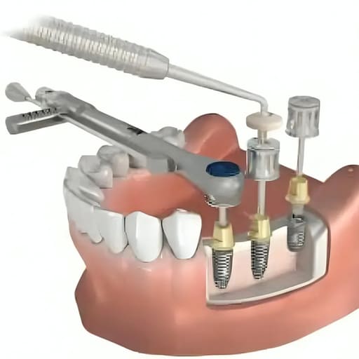 Dentaltech Prosthetic Hex Drivers - Nobel Biocare Implant Compatible
