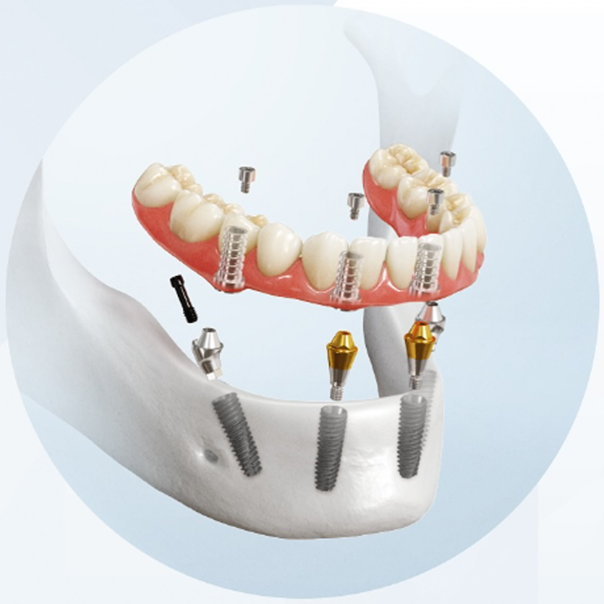Dentaltech Multi Unit Straight Abutments - Osstem | Dentium | DIO | Cowellmedi | Neobiotech | Dentis Compatible