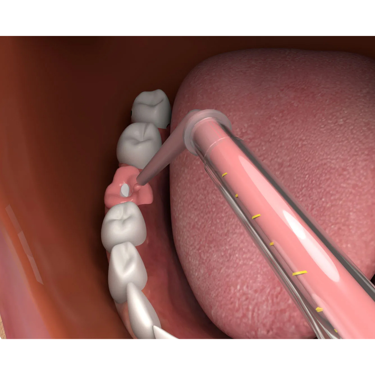 Seil Global Impression Saver Dispensing Gun & Tips Combo