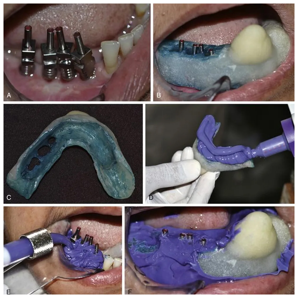 Dentaltech Universal Multi Unit Open Tray Impression Coping ∅4.8mm X 11mm - Osstem | Noris | Adin | Straumann | Nobel Biocare | Neodent | ICX Medentis Compatible (FHZYG)