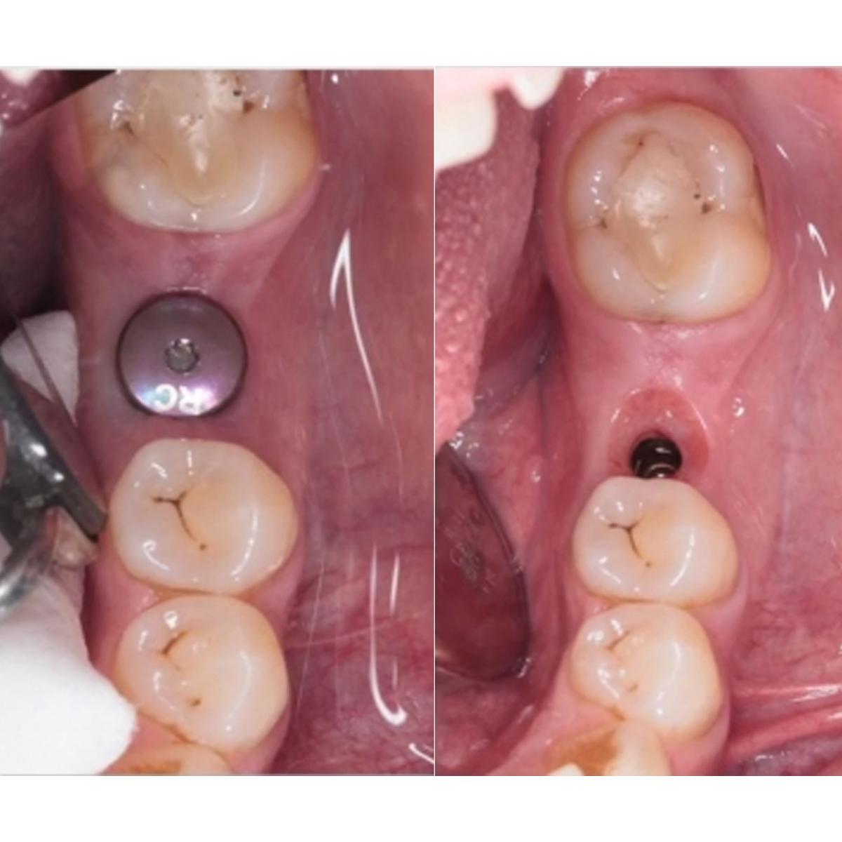 Dentaltech Healing Abutments - Straumann RC Implant Compatible
