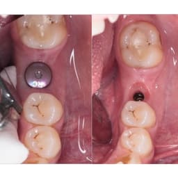 Dentaltech Healing Abutments - Straumann RC Implant Compatible - 6