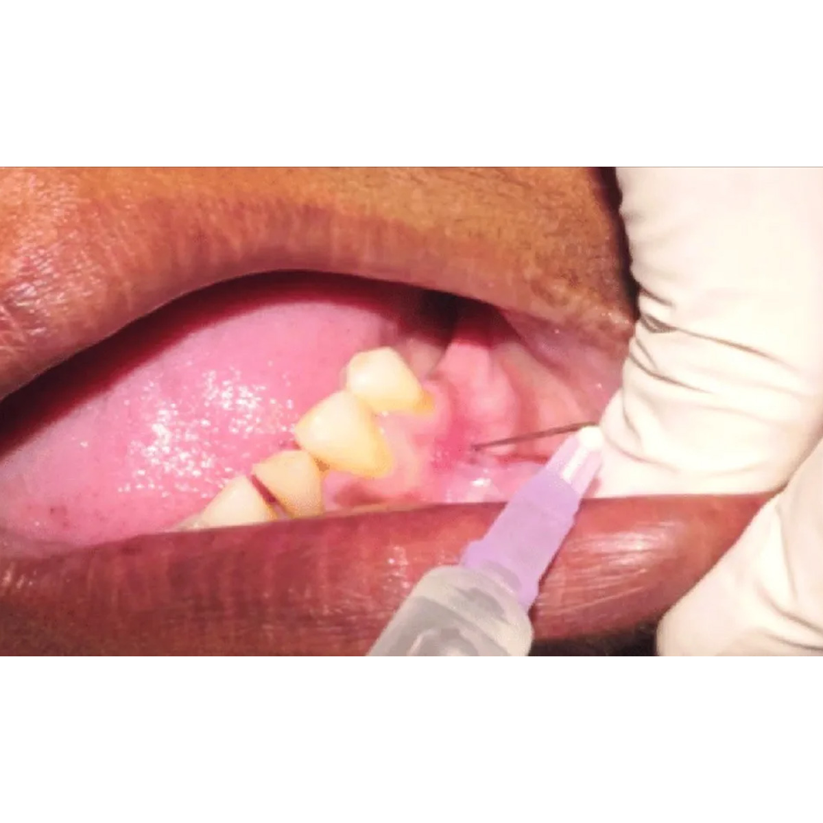 LifeJab Sterile Hypodermic Syringe With Needle 24 Gauge - 5ml