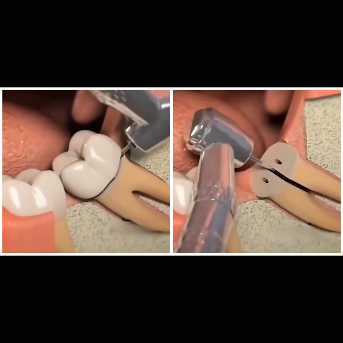 Mani Tooth Sectioning Surgical Carbide Airotor Burs 1559L