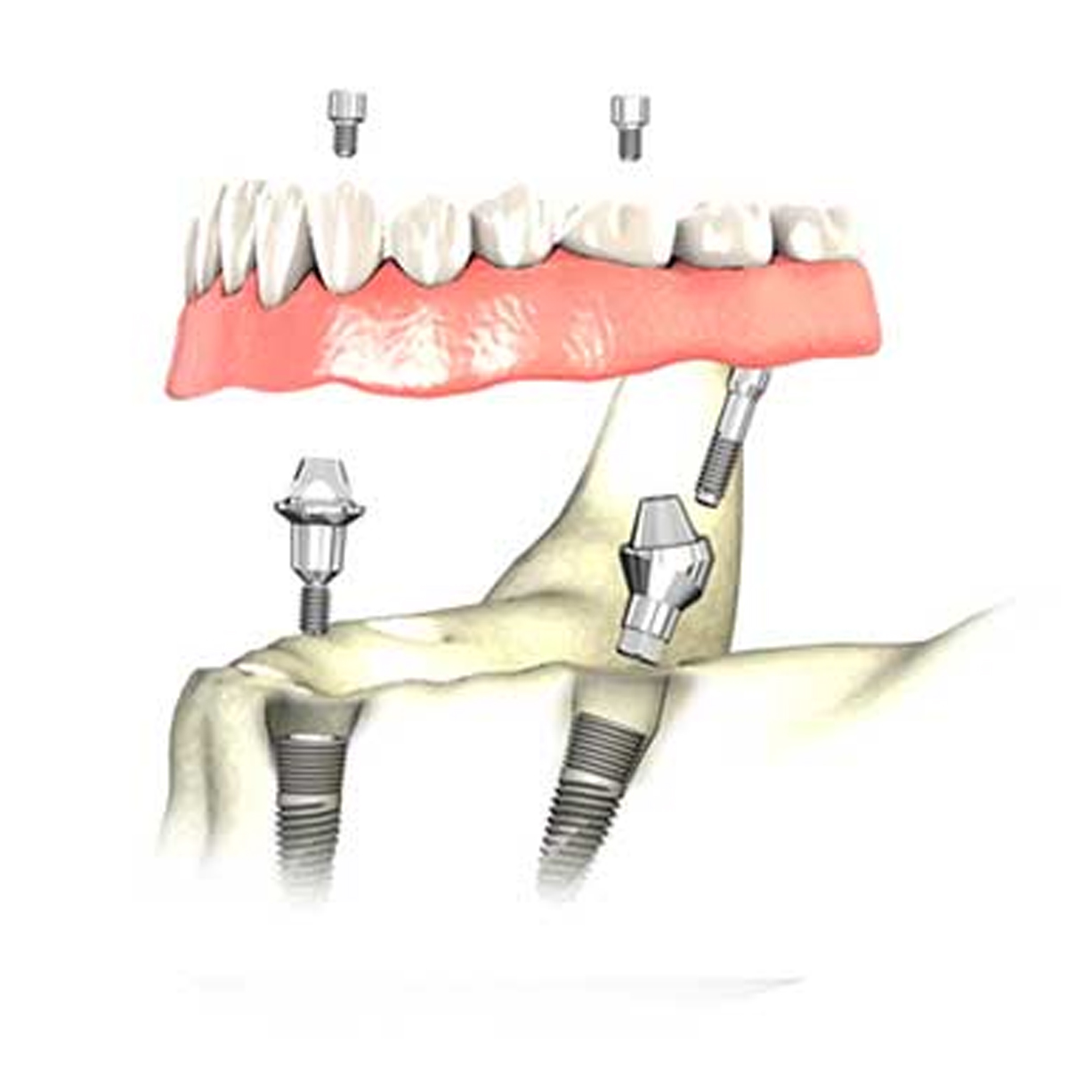 Dentaltech Multi Unit Angular Abutments Mini - Osstem Mini Implants Compatible