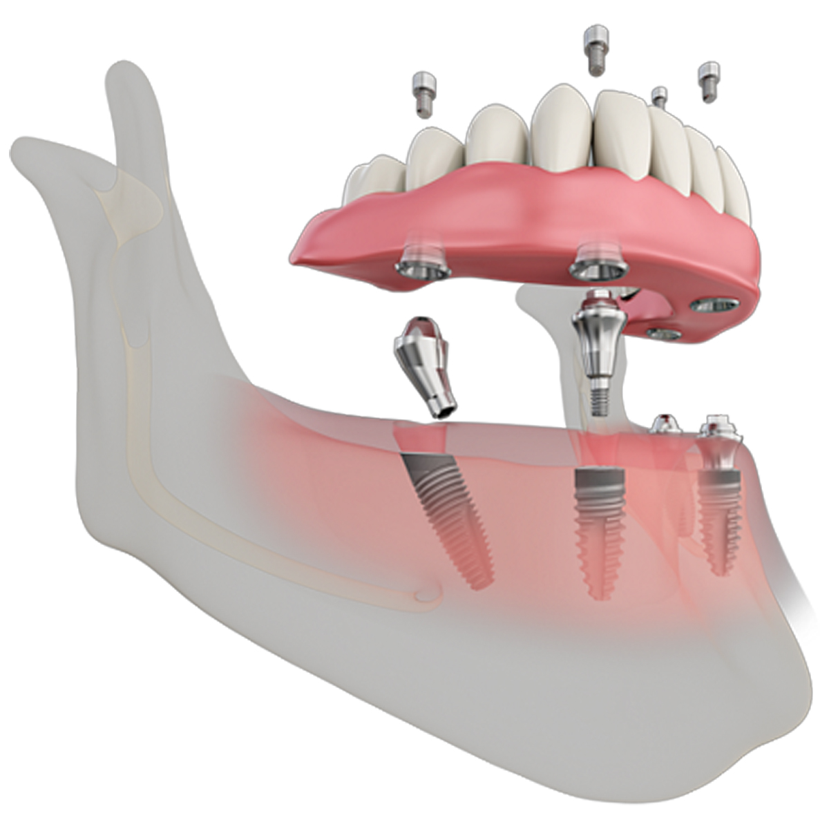 Dentaltech Multi Unit Angular Abutments Regular - Osstem | Dentium | DIO | Cowellmedi | Neobiotech | Dentis Compatible
