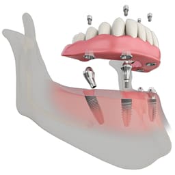 Dentaltech Multi Unit Angular Abutments Regular - Osstem | Dentium | DIO | Cowellmedi | Neobiotech | Dentis Compatible - 5