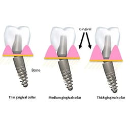 Dentaltech 15°Angular Abutments RS - Adin | Noris | MIS | AB Dental Compatible - 6