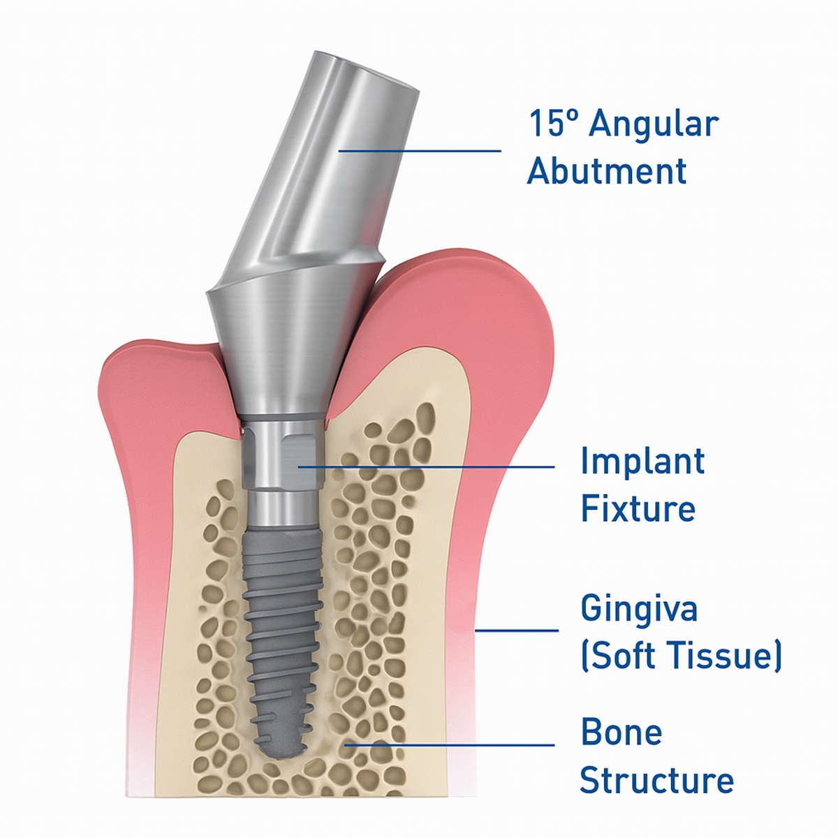 Dentaltech 15° Angular Abutments - Straumann RC Implant Compatible