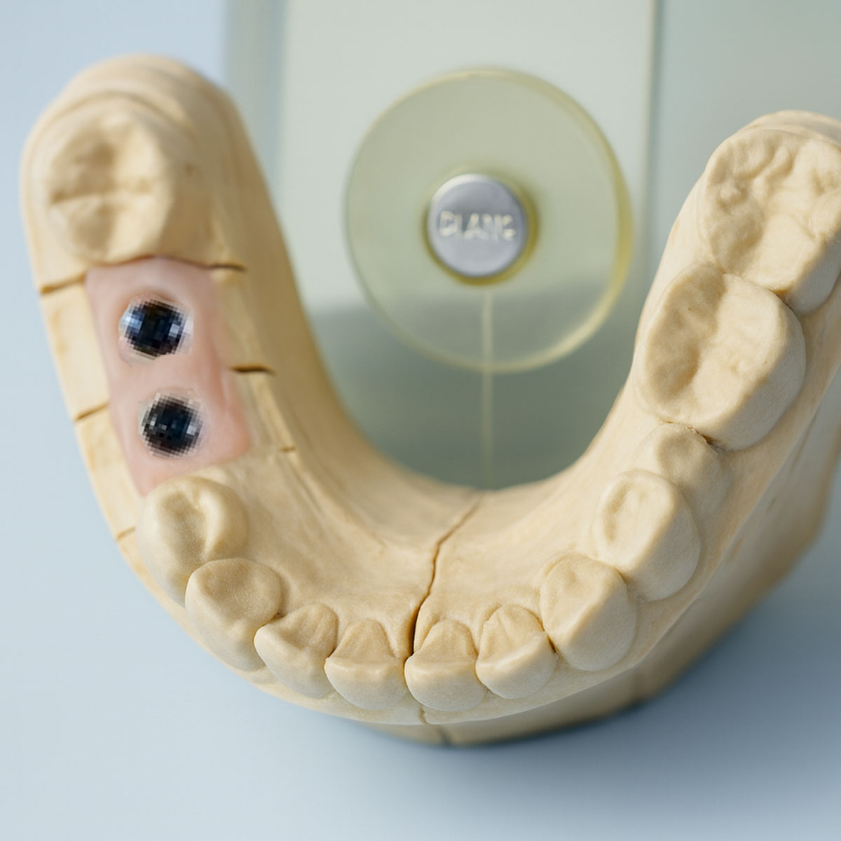 Dentaltech Implant Lab Analog - Adin | Noris | MIS | AB Dental Compatible