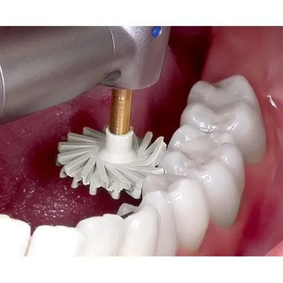 Youdent Diamond Polishing Kit For Composite (DRO804)