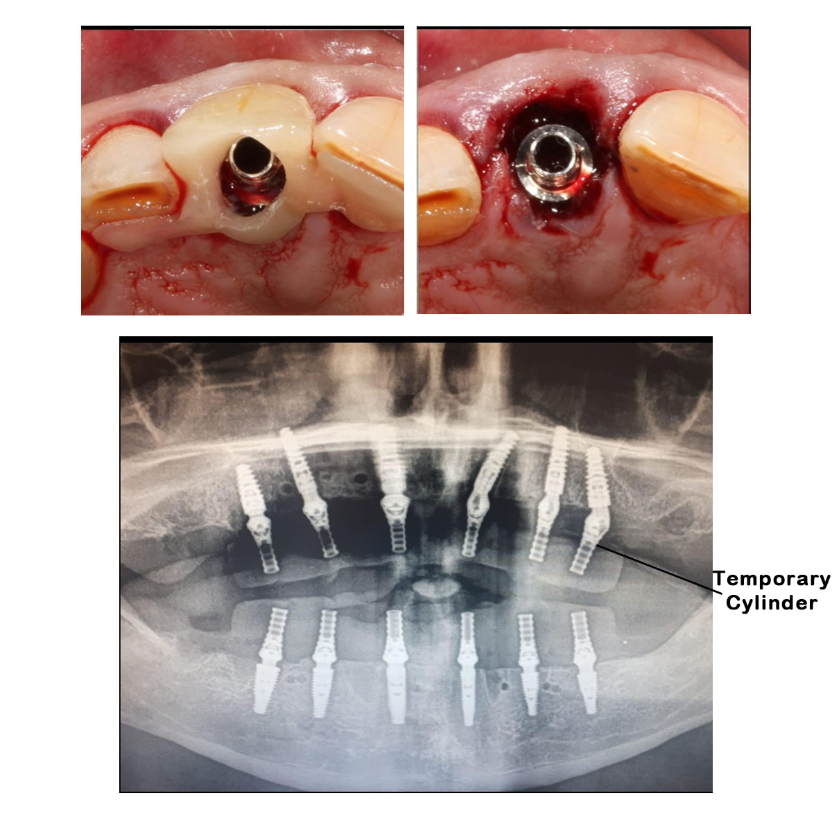 Dentaltech Universal Multi Unit Temporary Cylinder - Osstem | Noris | Adin | Straumann | Nobel Biocare | Neodent | ICX Medentis Compatible (FHTJD)
