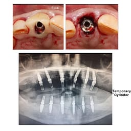 Dentaltech Universal Multi Unit Temporary Cylinder - Osstem | Noris | Adin | Straumann | Nobel Biocare | Neodent | ICX Medentis Compatible (FHTJD) - 5