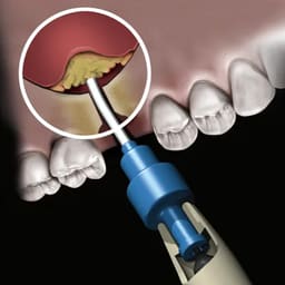 Novabone Dispensing Gun For Bone Graft Putty Cartridge - 4