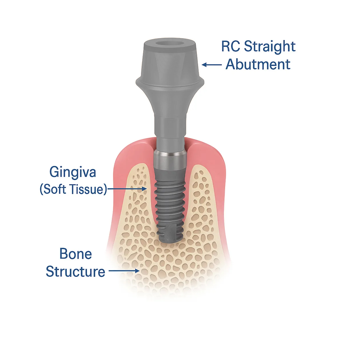 Dentaltech Straight Abutments - Straumann RC Implant Compatible