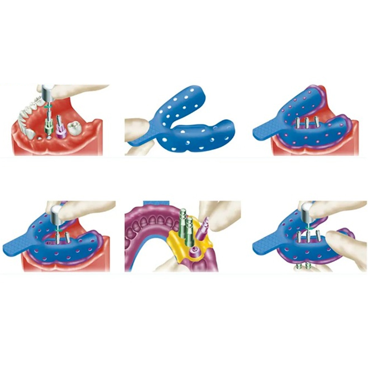 Dentaltech Open Tray Impression Copings - Osstem | Dentium | DIO | Cowellmedi | Neobiotech | Dentis Compatible