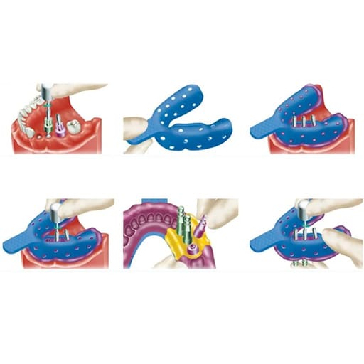 Dentaltech Open Tray Impression Copings - Osstem | Dentium | DIO | Cowellmedi | Neobiotech | Dentis Compatible