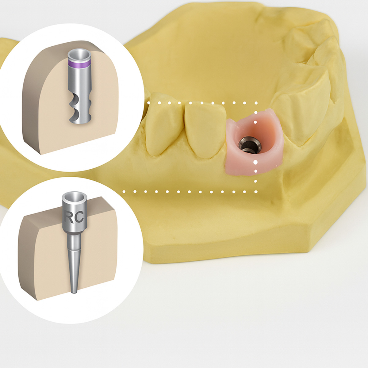 Dentaltech Lab Analog ∅4.0mm - Straumann RC Implant Compatible (ITI-RC 025.4101)