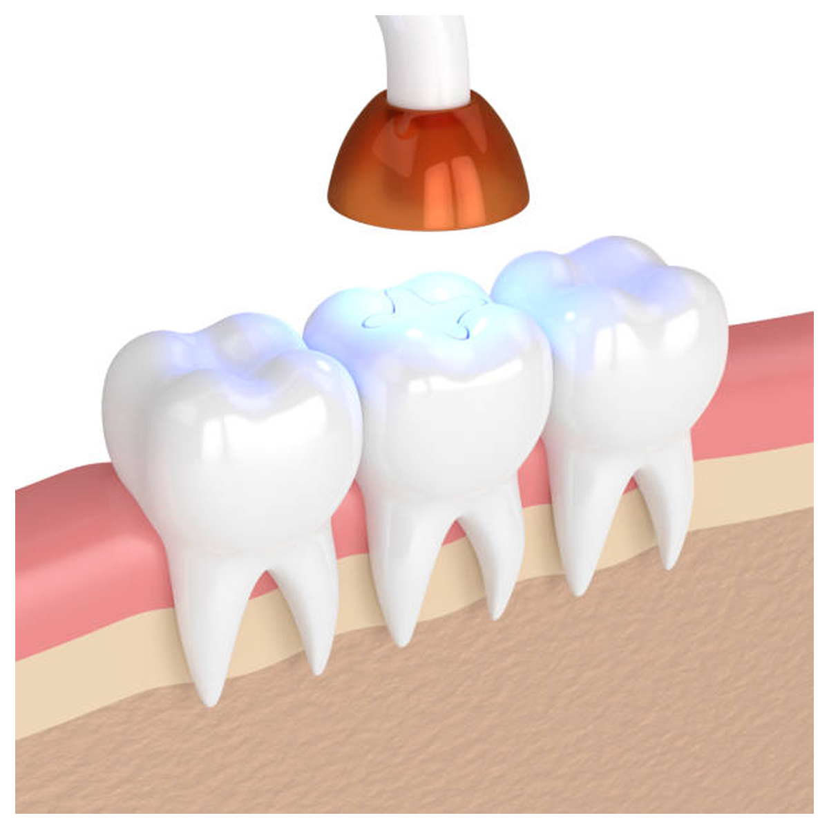 D-Tech Compomax Anterior Posterior Composite Refills